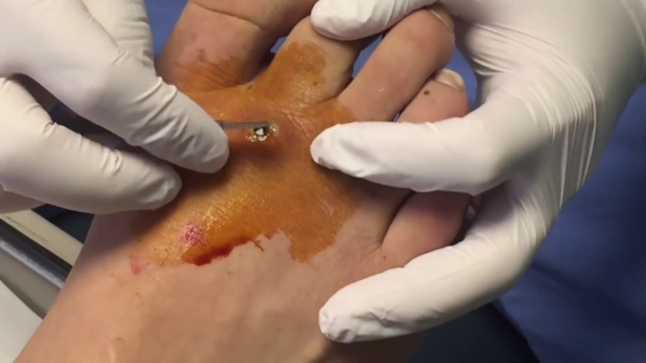 Guess What Popped Out of this Foot!  By Podiatrist Dr. Binh Nguyen