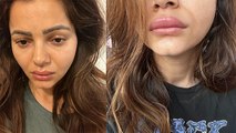 Rubina Dilaik Face Swelling के बाद हुआ बुरा हाल, Eyes, Lips पर दिखे Infection Side Effects | Boldsky