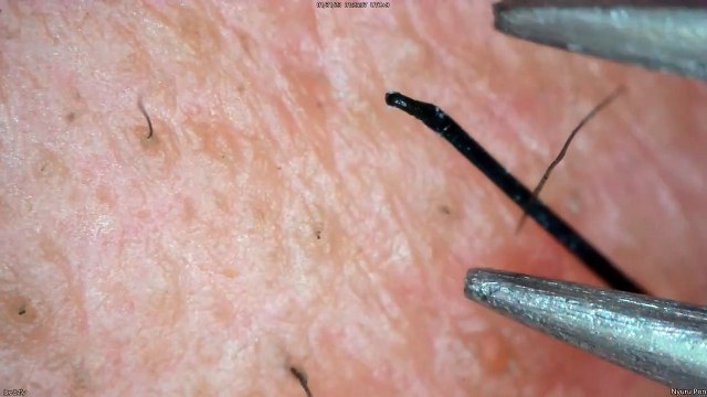 0332 pull out hair around the chin