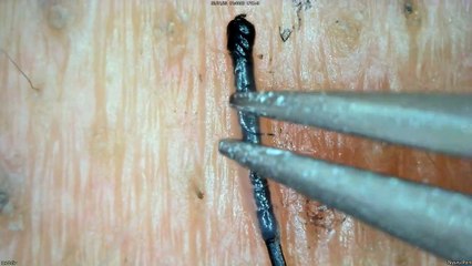 0337 pull out hair around the chin