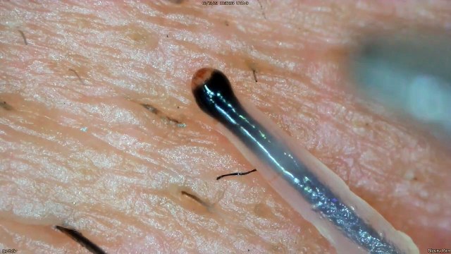 0339 pull out hair Around the nose and lips