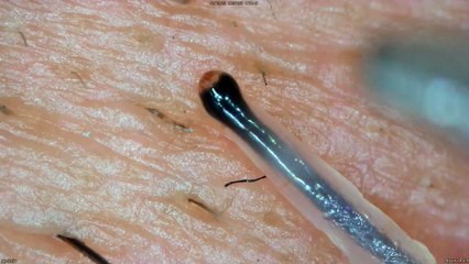 0339 pull out hair Around the nose and lips