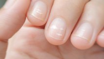 Weiße Flecken auf Fingernägeln: Woher kommen sie und was kann man dagegen tun?
