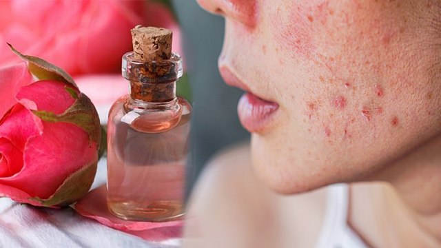 चेहरे पर गुलाब जल लगाने से क्या होता है | Chehre Par Gulab Jal Lagane Ke Nuksan | Boldsky