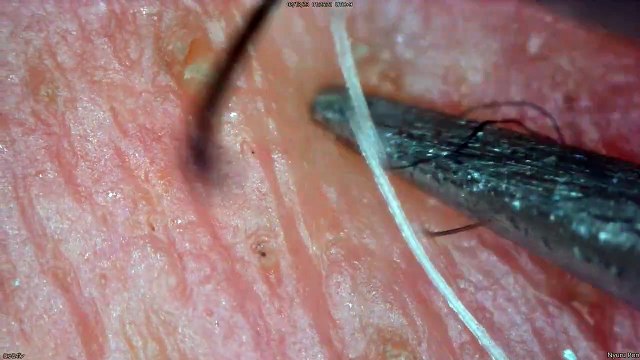 0342 pull out hair Around the nose and lips