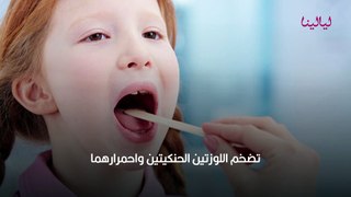 أعراض التهاب اللوزتين عند الأطفال وعلاجه