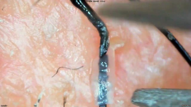 0346 pull out hair Around the nose and lips