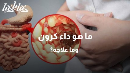 داء كرون بين الأسباب، الأعراض والعلاج