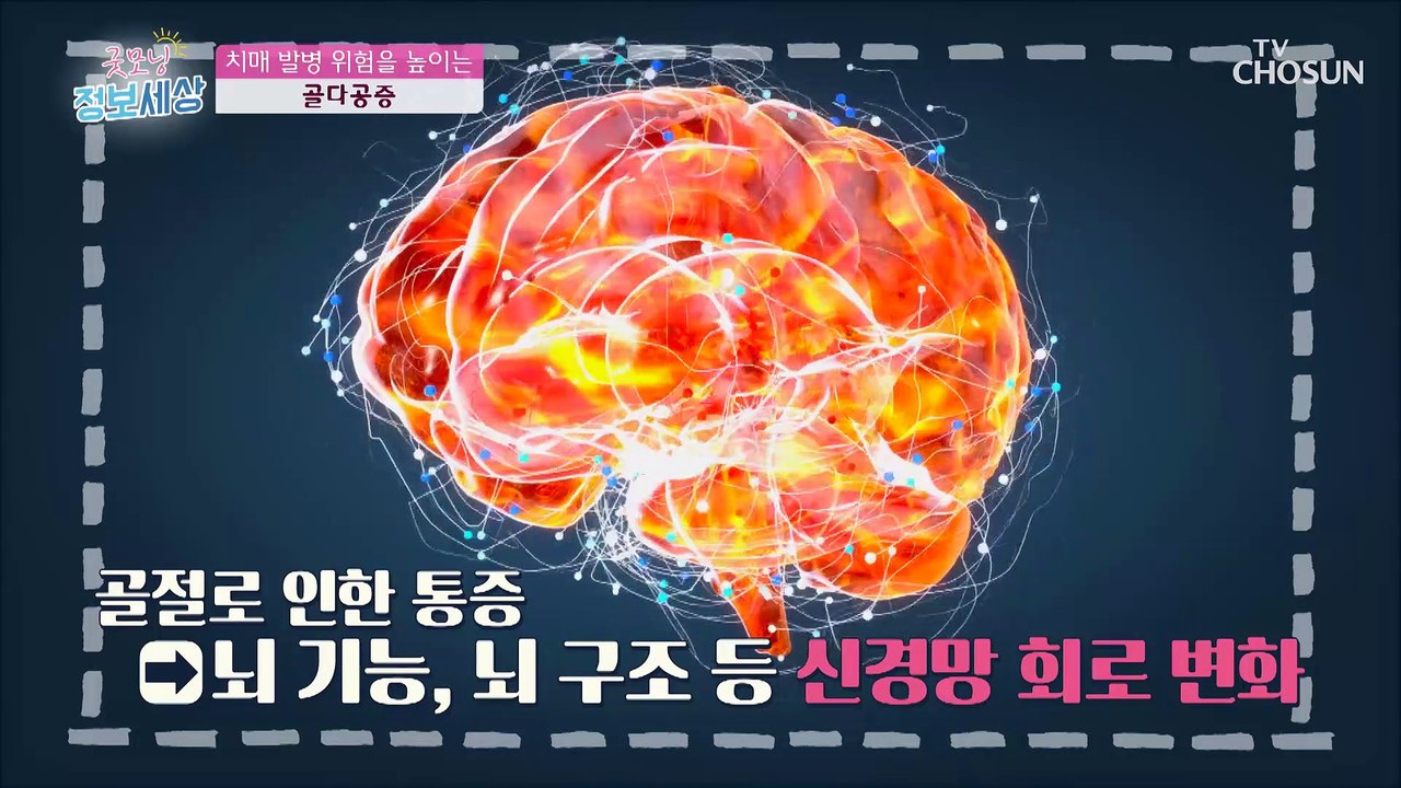 치매 발병률을 높이는 골다공증으로 인한 골절 TV CHOSUN 230221 방송