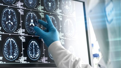 Fortschritt in der Demenzforschung: Forscher:innen machen wichtige Entdeckung