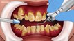 ASMR 리얼함 주의! 신기한 치아교정 애니메이션 | 치아 발치 | 덧니 | Amazing braces animation | Oddly Satisfying | Dental care