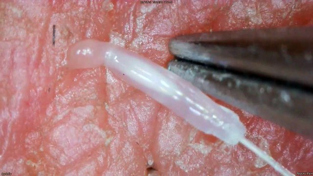 0348 pull out hair around the chin