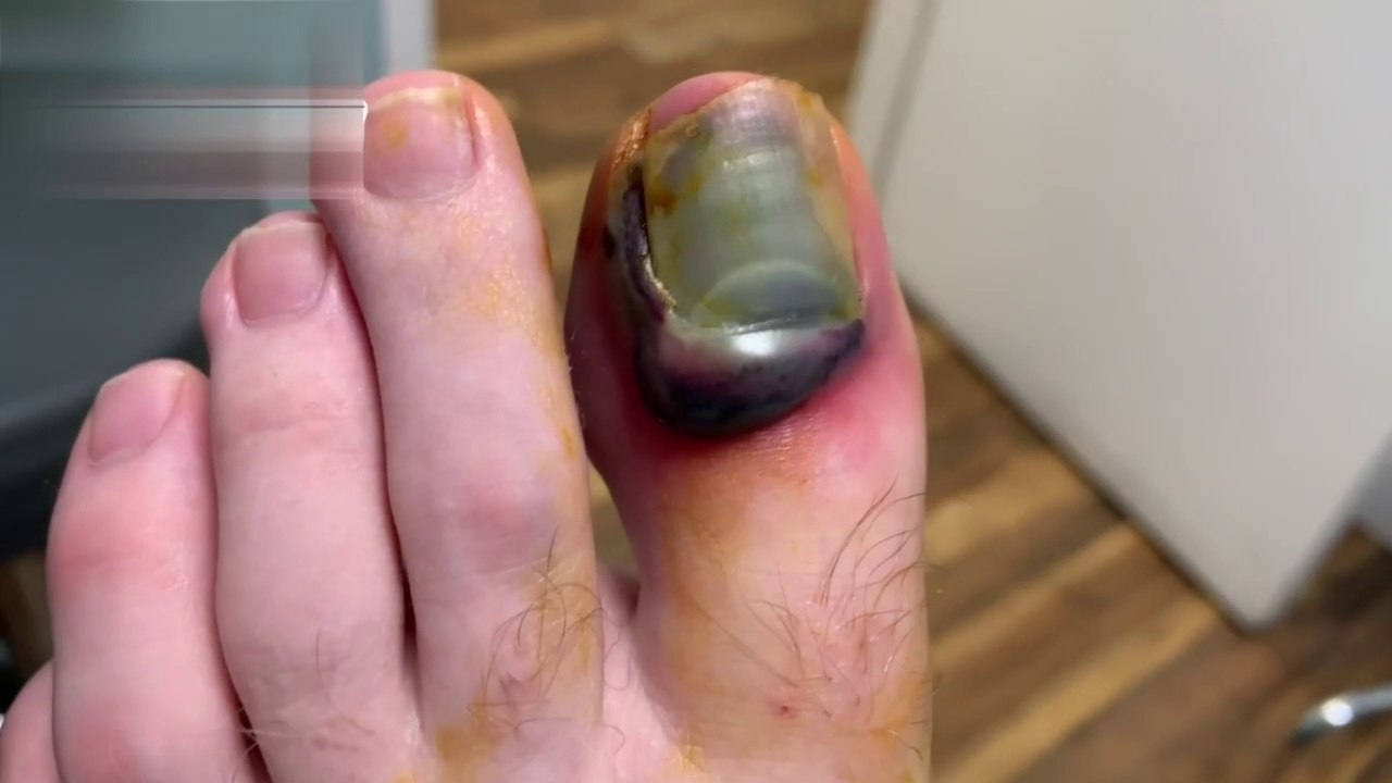KNOCKED OUT NAIL