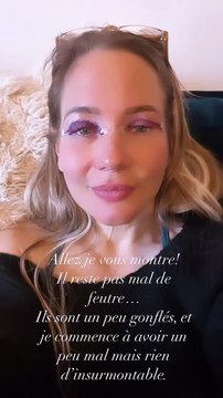 Pour l'instant, ses yeux sont encore gonflés et marqués par des traces de feutre violet.Louise Orgeval dévoile le résultat de sa chirurgie esthétique.