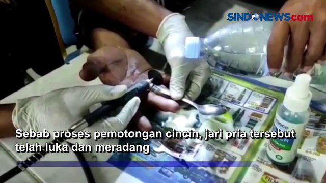 Dramatis, Evakuasi Cincin Batu Akik Tersangkut di Jari yang Luka dan Bengkak