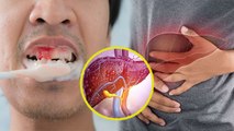 ब्रश करते वक्त दांत से खून आना, Fatty Liver का Symptom | Brush Karte Waqt Dant Se Khoon Ana |Boldsky