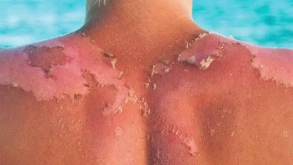 bd-secuelas-en-la-piel-por-exposicion-al-sol-020323