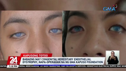 Babaeng may congenital hereditary endothelial dystrophy, napaoperahan na ng GMA Kapuso Foundation | 24 Oras