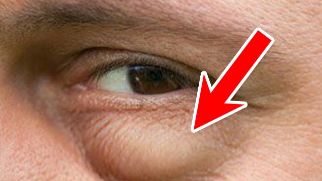 आंख के नीचे सूजन क्यों होती है | Ankh Ke Niche Sujan Ka Karan | Boldsky