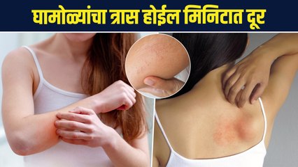 घामोळ्यांनी हैराण आहात? पहा बेस्ट उपाय | How to Get Rid of Prickly Heat | Prickly Heat Rash | AI 2