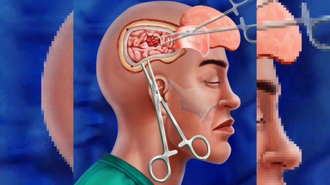 Watch this Satisfying 3D Animation of a Craniectomy Procedure! #ASMR #MrDevendra