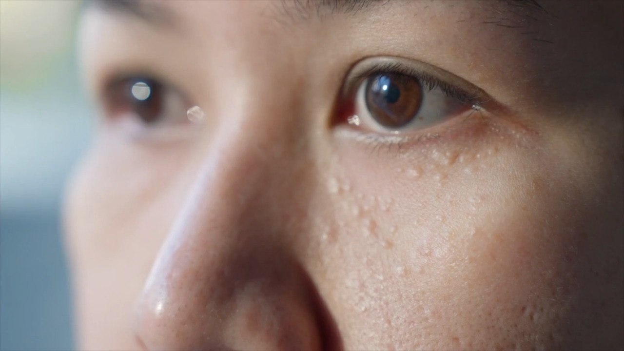 How to Treat Milia  The Small White Bumps On Your Face