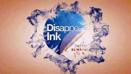 The Most Common Questions About Laser Tattoo Removal Answered!