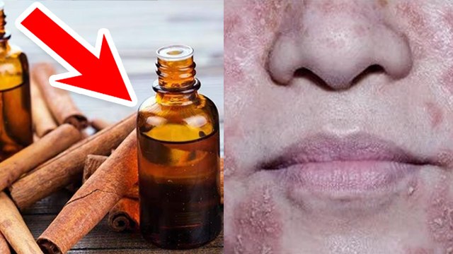 फंगल इंफेक्शन को कैसे ठीक करें | Fungal Infection Ko Kaise Khatam Kare | Boldsky