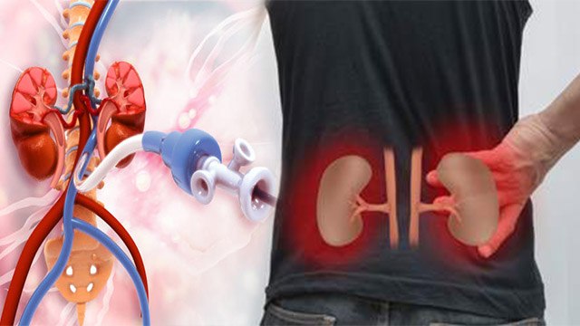 Kidney Failure के बाद Dialysis कैसे होता है । Dialysis कितनी बार होता है । Boldsky