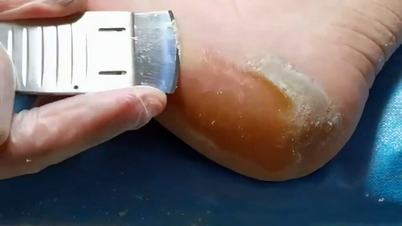 scuffed heels Treatment for cracked heels and elimination of dead skin. Foot corn removal and callus eradication.