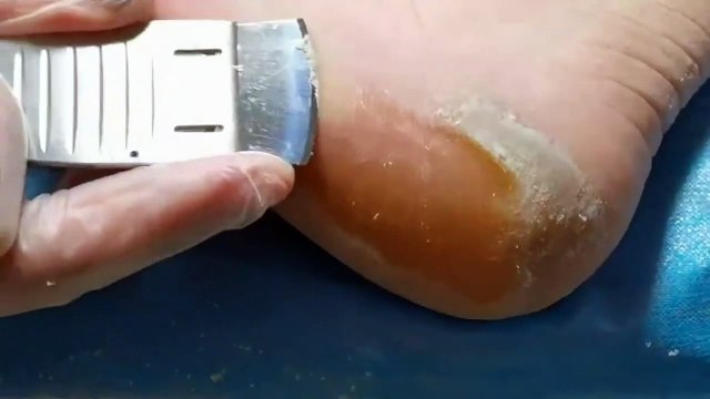 scuffed heels Treatment for cracked heels and elimination of dead skin. Foot corn removal and callus eradication.