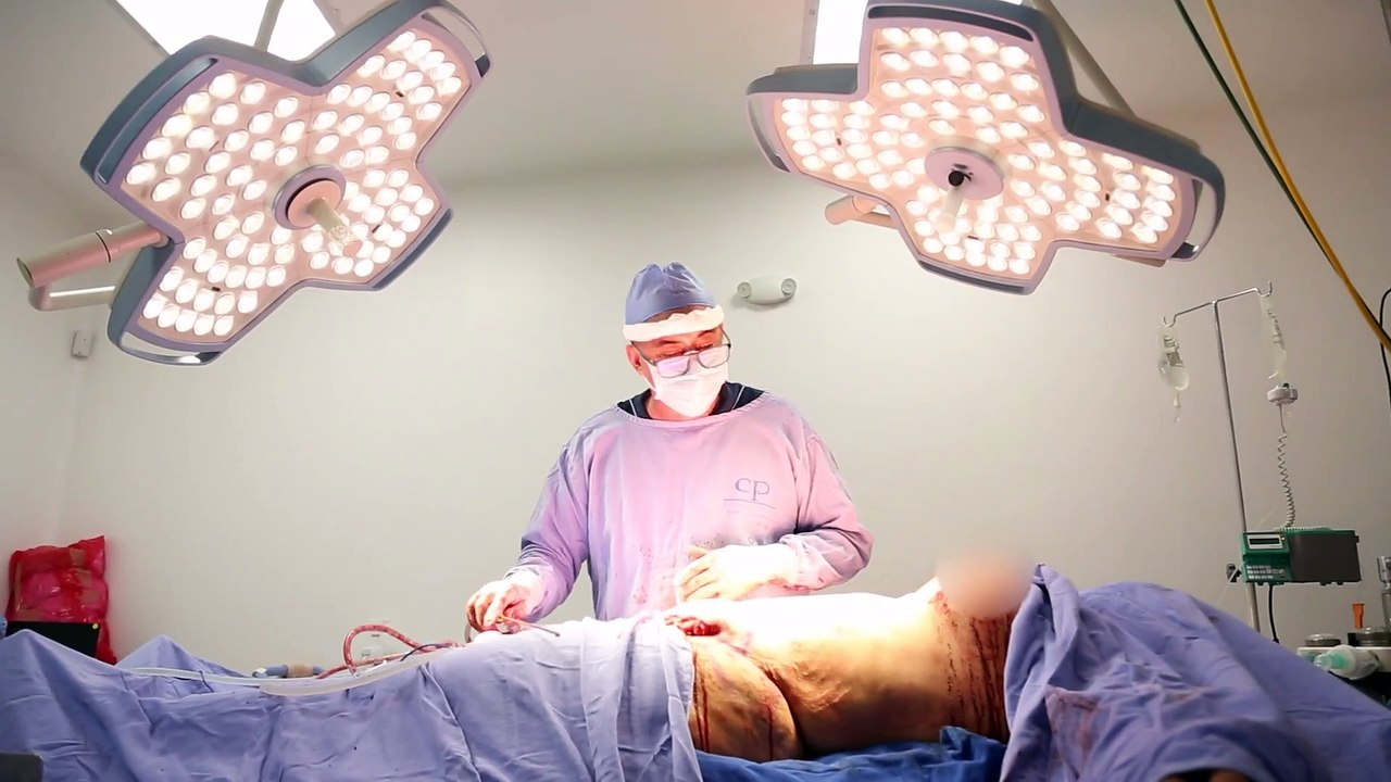 ABDOMINOPLASTIA Y PEXIA - DR. RICARDO BONILLA