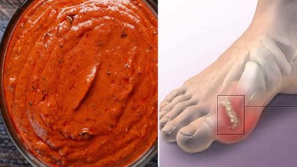 यूरिक एसिड को दही-लहसुन चटनी से कैसे करें खत्म | Chutney For Uric Acid | Boldsky