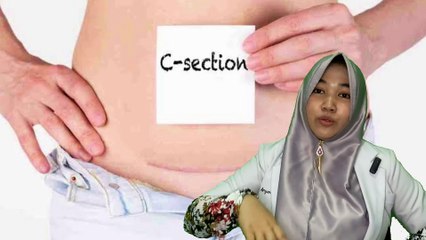 SETELAH OPERASI SAESAR MELAHIRKAN ( SC ) KAPAN BOLEH AKTIVITAS #melahirkan #operasi