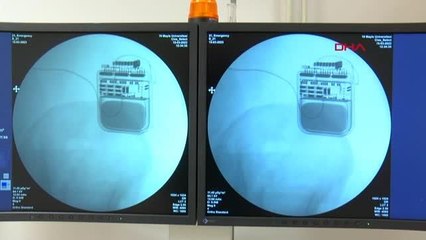 3 KERE AMELİYAT OLDU, GEÇMEYEN AĞRILARI 'AĞRI PİLİ' İLE SON BULDU