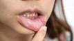 Is It a Canker Sore or a Cold Sore?–Differences, Causes, and Treatment
