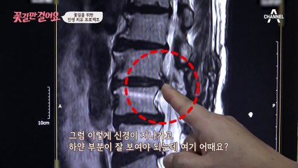 경자 씨를 괴롭힌 통증의 원인! 척추관협착증을 극복할 방법은?
