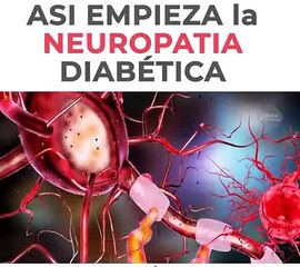 03. Asi Empieza La Neuropatia Diabetica