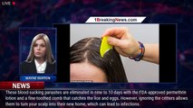 Shocking video reveals happens if you don't treat head lice - 1breakingnews.com
