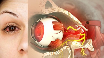 ग्लूकोमा का इलाज क्या है | ग्लूकोमा कैसे ठीक करें | Glaucoma Kaise Theek Kare | Boldsky