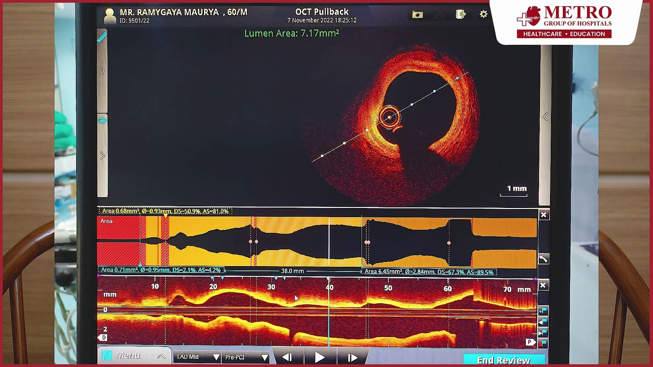 How is OCT Helpful during PCTA? Explained by Dr. Gyanti R.B. Singh | Metro Hospital Noida