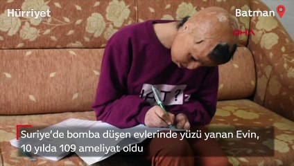 Evin, 10 yılda 109 ameliyat oldu: Yüz nakli olmak istiyorum