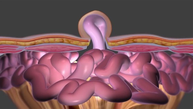 bd-complicaciones-de-una-hernia-150323