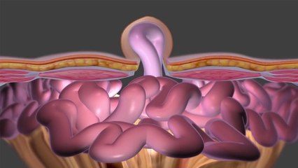 bd-complicaciones-de-una-hernia-150323