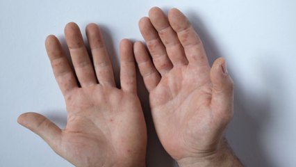 8 Types of Rashes That Can Be a Sign of COVID 19