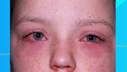 bd-conjuntivitis-alergica-y-sus-tratamientos-160323