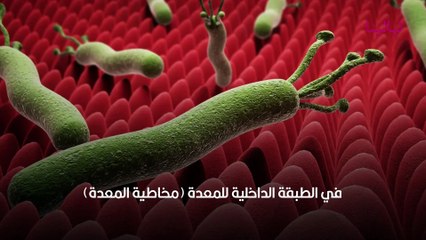أسباب وأعراض وعلاج جرثومة المعدة (Helicobacter Pylori)