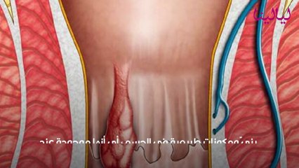 أسباب البواسير، أعراضها وعلاجها