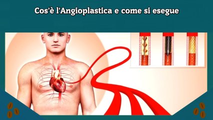 Cos'è l'Angioplastica e come si esegue