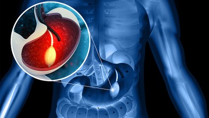 bd-balon-gastrico-tratamiento-para-bajar-de-peso-200323